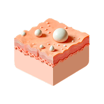 Акне