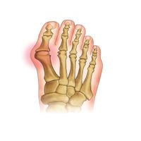 Приспособление корригирующее для пальцев ног при Hallux-Valgus Orliman HV-33D р. M миниатюра фото №2