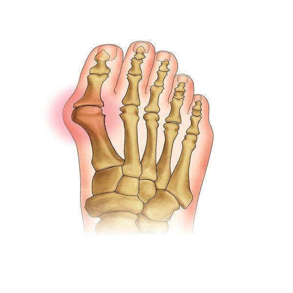 Приспособление корригирующее для пальцев ног при Hallux-Valgus Orliman HV-33D р. M фото №2