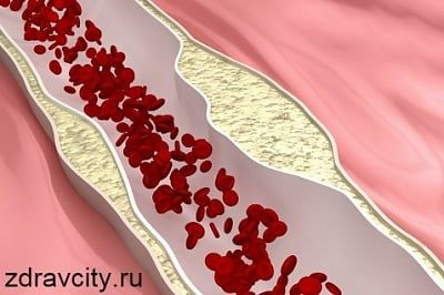 Норма холестерина в крови — какая она?