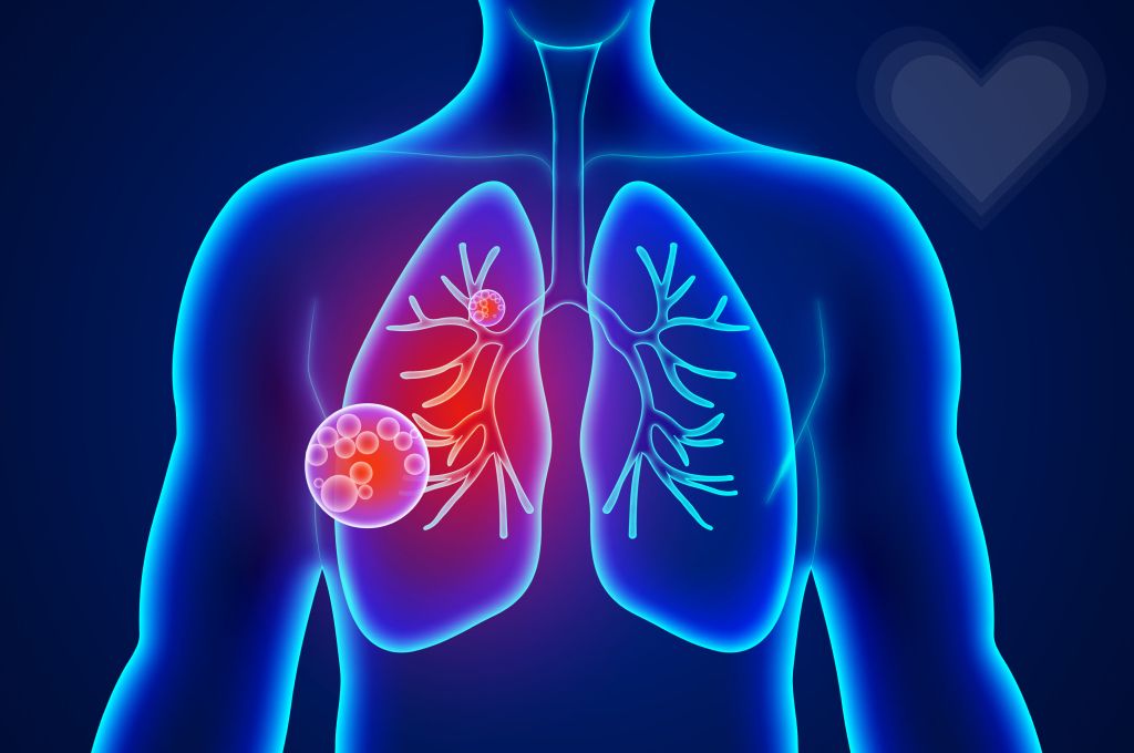 Заболевания легких|Симптомы и лечение|European Lung Foundation